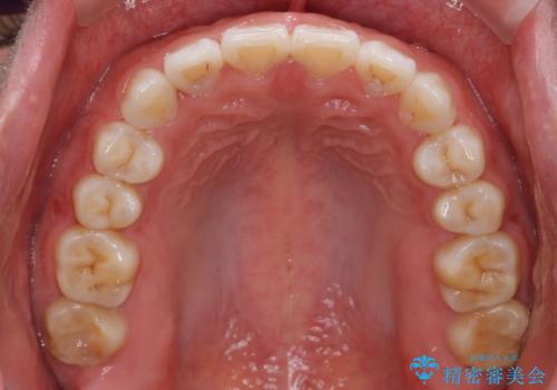 インビザライン　気になるすきっ歯の改善の治療後
