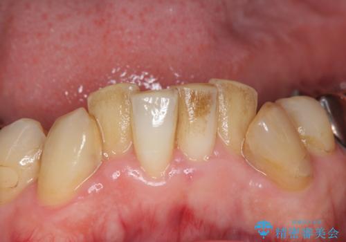 付着したステインをPMTCで除去の治療前