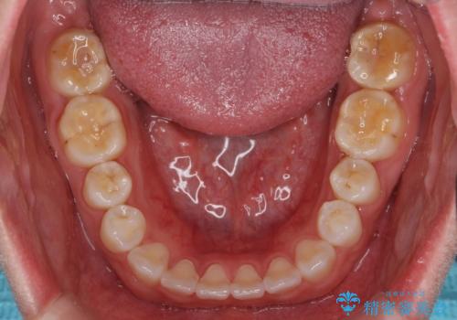 インビザライン　気になるすきっ歯の改善の治療後