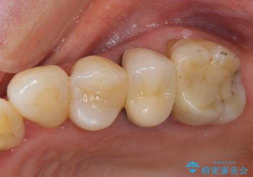 歯肉の退縮により歯根が見える　オールセラミッククラウンによる審美歯科治療の症例 治療前