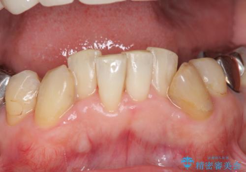 付着したステインをPMTCで除去の治療後