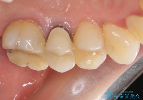 歯肉の退縮により歯根が見える オールセラミッククラウンによる審美歯科治療の治療前