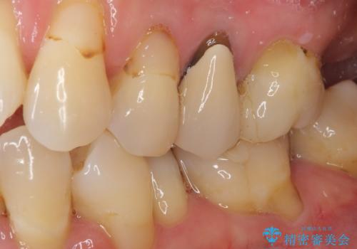 歯肉の退縮により歯根が見える オールセラミッククラウンによる審美歯科治療の治療前