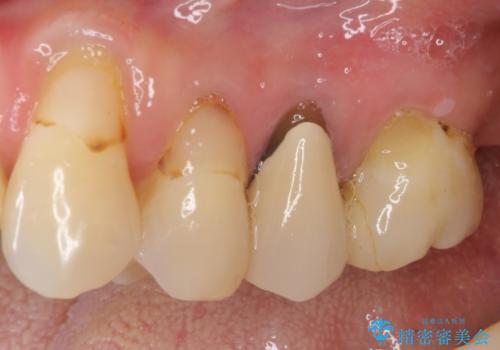 歯肉の退縮により歯根が見える　オールセラミッククラウンによる審美歯科治療の治療前