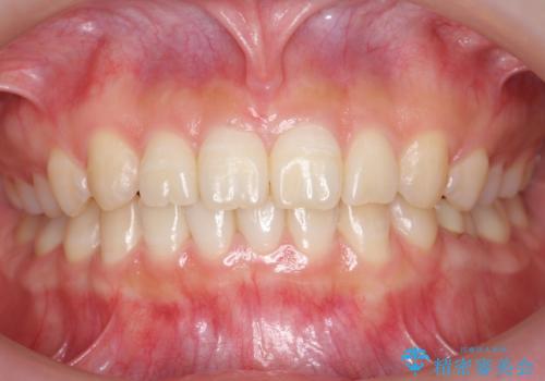 前歯のねじれ 乳歯を残して矯正治療の症例 治療後