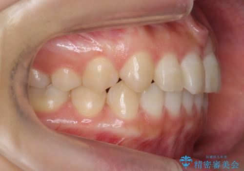前歯のねじれ　乳歯を残して矯正治療の治療後