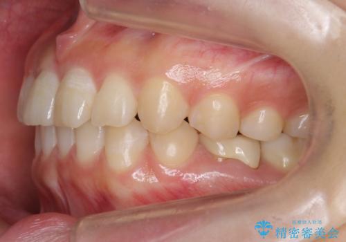 前歯のねじれ 乳歯を残して矯正治療の治療後