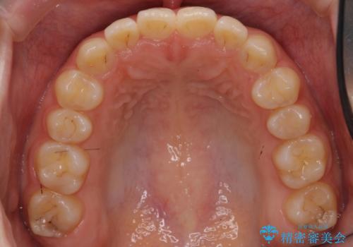 前歯のねじれ 乳歯を残して矯正治療の治療後