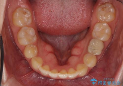 前歯のねじれ 乳歯を残して矯正治療の治療後