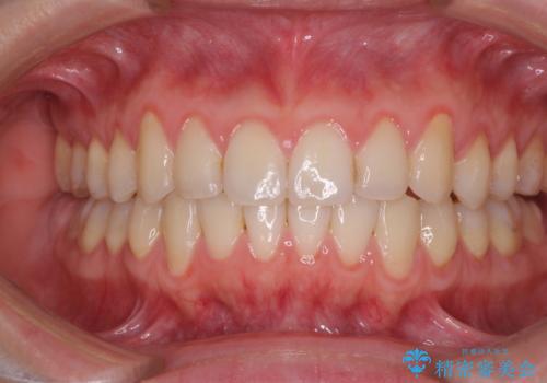 前歯のデコボコを治したい　インビザラインによる矯正治療の症例 治療後