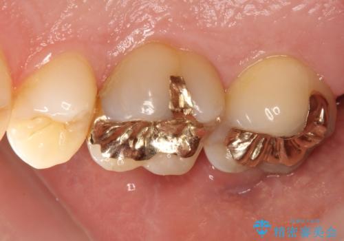 奥歯のゴールドインレーによる虫歯治療の治療後