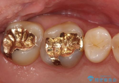 奥歯のゴールドインレーによる虫歯治療の治療後