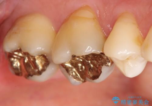 奥歯のゴールドインレーによる虫歯治療の治療後