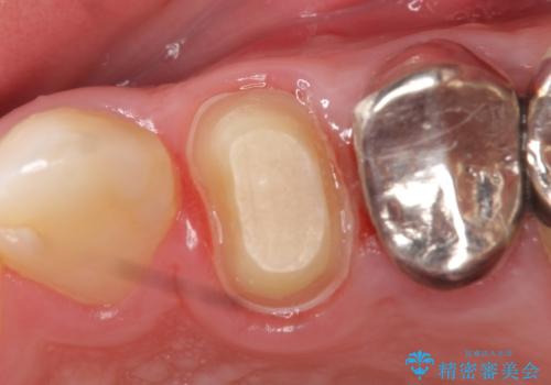 オールセラミッククラウン　歯茎にできた膿の出口(フィステル)の治療の治療中
