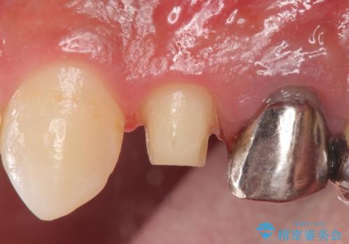 オールセラミッククラウン　歯茎にできた膿の出口(フィステル)の治療の治療中