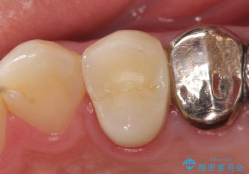 オールセラミッククラウン　歯茎にできた膿の出口(フィステル)の治療の治療後