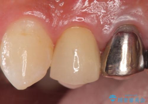 オールセラミッククラウン　歯茎にできた膿の出口(フィステル)の治療の治療後