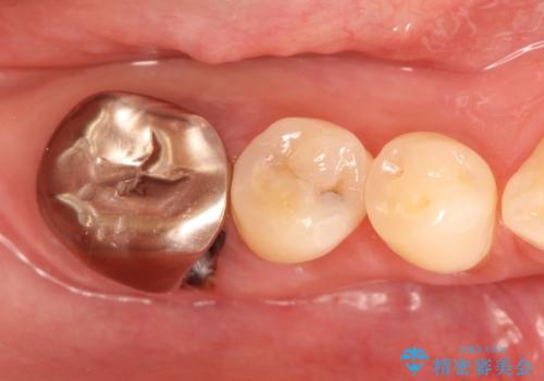 奥歯が痛い。抜歯～奥歯のインプラント　の治療前