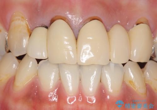 オールセラミッククラウン　気になる歯茎と被せ物の隙間の改善の治療前