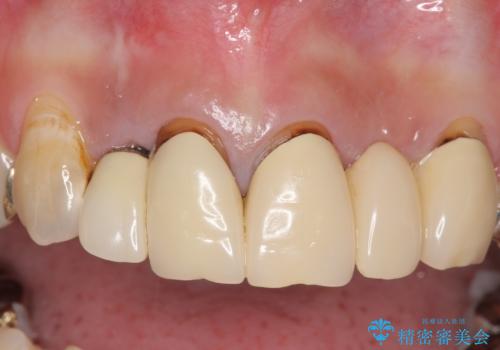 オールセラミッククラウン 気になる歯茎と被せ物の隙間の改善の症例 治療前