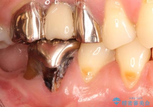 奥歯が痛い。抜歯~奥歯のインプラント の治療前