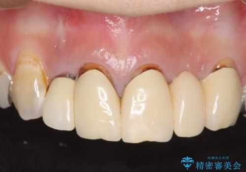 オールセラミッククラウン 気になる歯茎と被せ物の隙間の改善