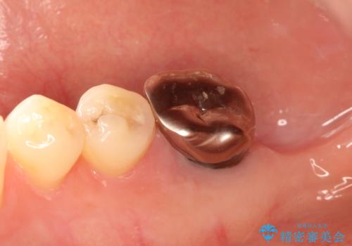 奥歯が痛い。抜歯~奥歯のインプラント の治療前