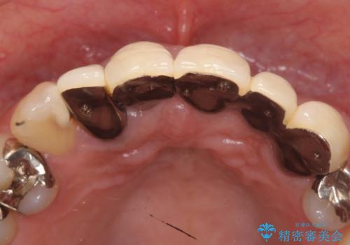 オールセラミッククラウン　気になる歯茎と被せ物の隙間の改善の治療前