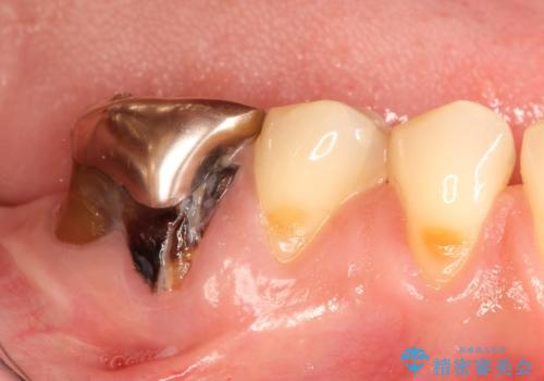 奥歯が痛い。抜歯~奥歯のインプラント の症例 治療前