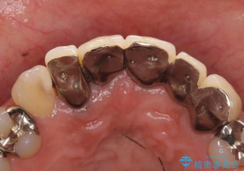 オールセラミッククラウン 気になる歯茎と被せ物の隙間の改善の治療前
