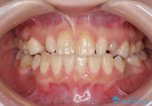 欠損と残存乳歯 矯正治療とインプラント治療の治療中