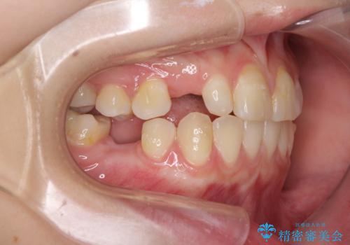 欠損と残存乳歯 矯正治療とインプラント治療の治療中