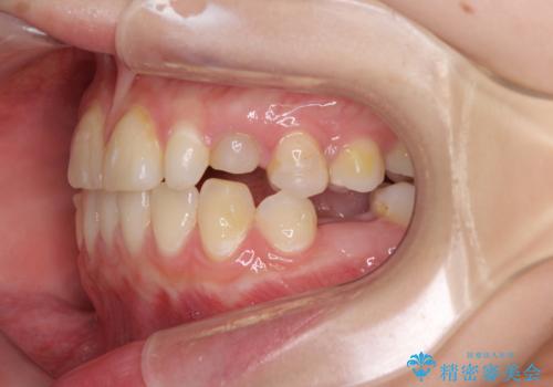 欠損と残存乳歯　矯正治療とインプラント治療の治療中
