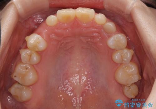 欠損と残存乳歯 矯正治療とインプラント治療の治療中