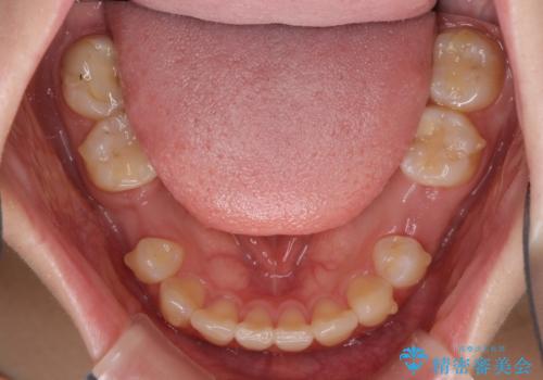 欠損と残存乳歯 矯正治療とインプラント治療の治療中