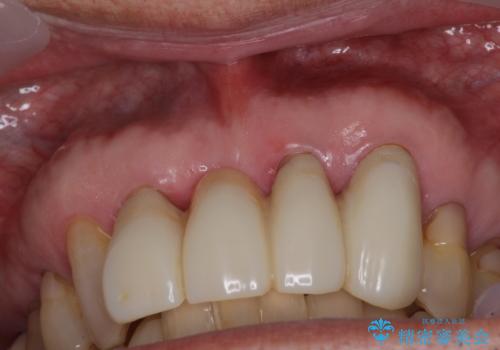 矯正治療と歯周外科処置を併用した審美歯科治療の治療前