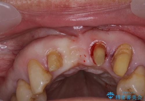 矯正治療と歯周外科処置を併用した審美歯科治療の治療中