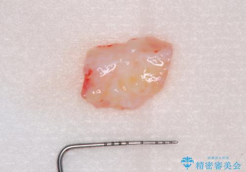 矯正治療と歯周外科処置を併用した審美歯科治療の治療中