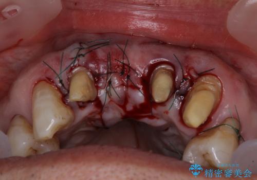 矯正治療と歯周外科処置を併用した審美歯科治療の治療後