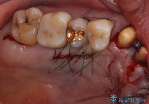 矯正治療と歯周外科処置を併用した審美歯科治療の治療前