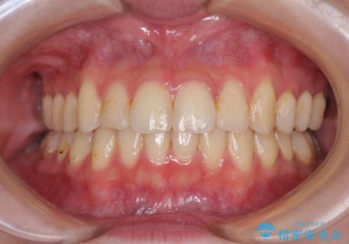 軽度な後戻りをインビザライン・ライトで改善