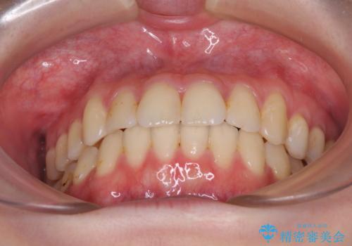 軽度な後戻りをインビザライン・ライトで改善の治療後