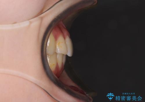 軽度な後戻りをインビザライン・ライトで改善の治療後