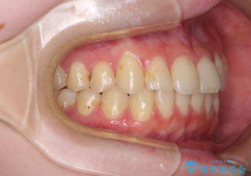 軽度な後戻りをインビザライン・ライトで改善の治療後