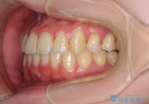 軽度な後戻りをインビザライン・ライトで改善の治療後