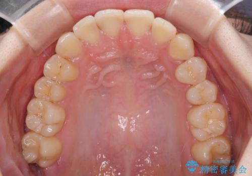 軽度な後戻りをインビザライン・ライトで改善の治療後