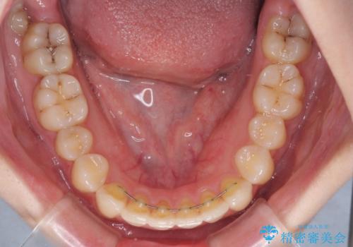 軽度な後戻りをインビザライン・ライトで改善の治療後