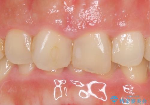 オールセラミッククラウン 長さが気になる前歯の改善の症例 治療前