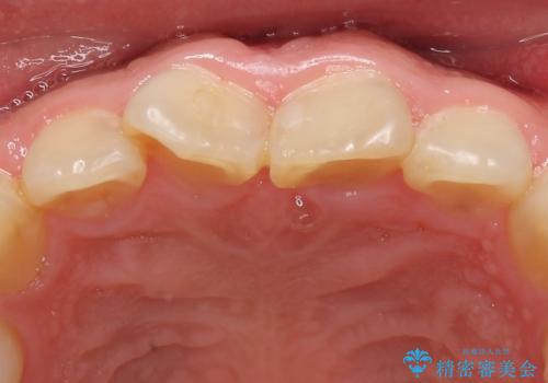 オールセラミッククラウン 長さが気になる前歯の改善の治療前
