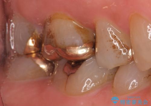 オールセラミッククラウン・セラミックインレー 歯茎より深い虫歯の治療の治療前